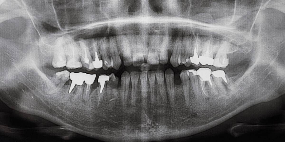 Injerto De Hueso Dental Su Importancia En Implantes Dentales