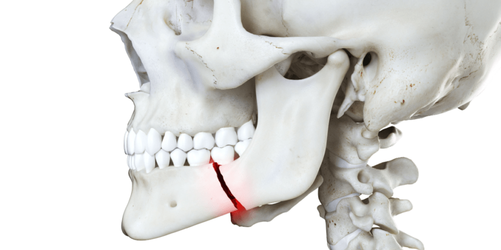 fractura mandibular