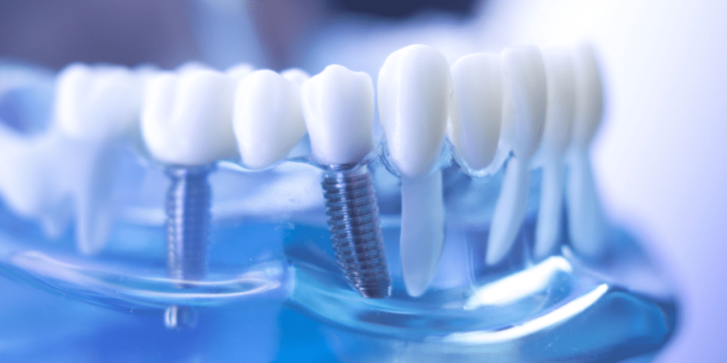 gap en implantes dentales