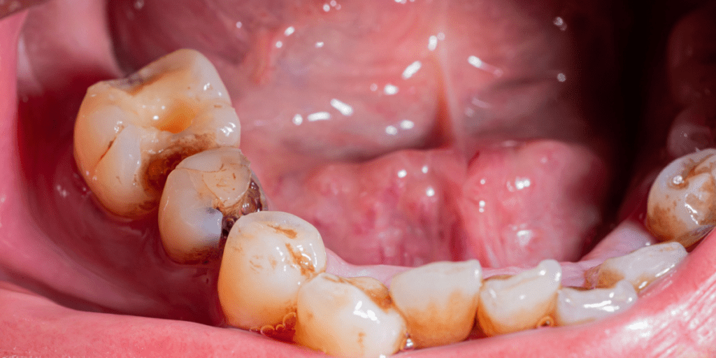 caries interproximales